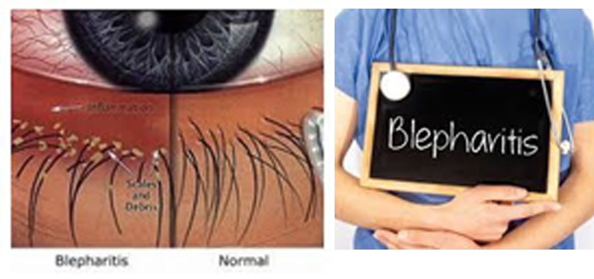 WHY DO YOU NEED TO CLEAN YOUR EYELASH EXTENSIONS